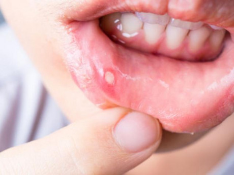 Nhiệt miệng nên ăn gì để mau khỏi?