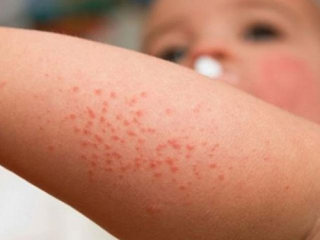 Nguyên nhân nổi mụn nước ở tay và cách chữa trị