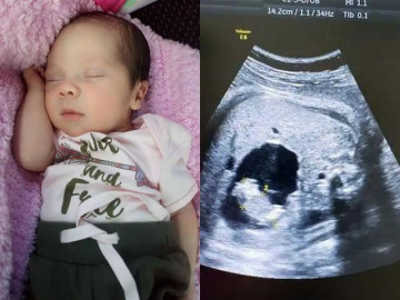 Con gái vừa được 1 ngày tuổi, mẹ sốc nặng khi bác sĩ nói con cần "mổ đẻ"