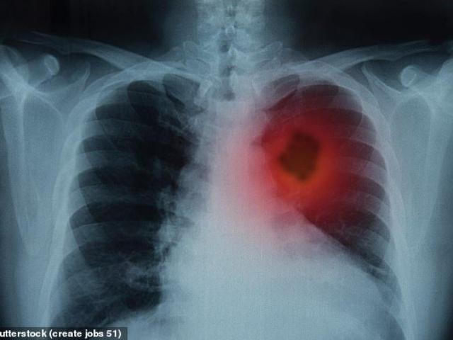 Chỉ một thao tác đơn giản với ngón tay có thể biết mình có mắc ung thư phổi hay không