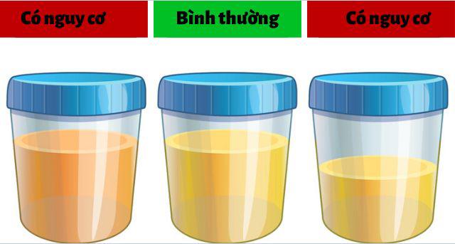 Nếu có 5 dấu hiệu này, nên đi khám thận ngay kẻo bên trong chứa đầy sỏi mà không biết - 2