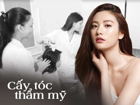 Cấy tóc thẩm mỹ - giải pháp an toàn và hiệu quả cho mái tóc thưa, hói, gãy rụng nhiều
