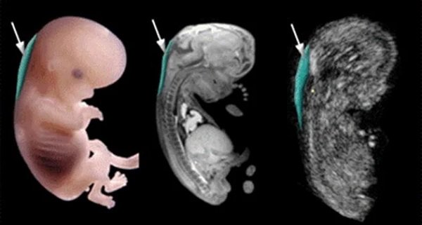 Thai nhi 12 tuần đo độ mờ da gáy bao nhiêu là bình thường? - 2