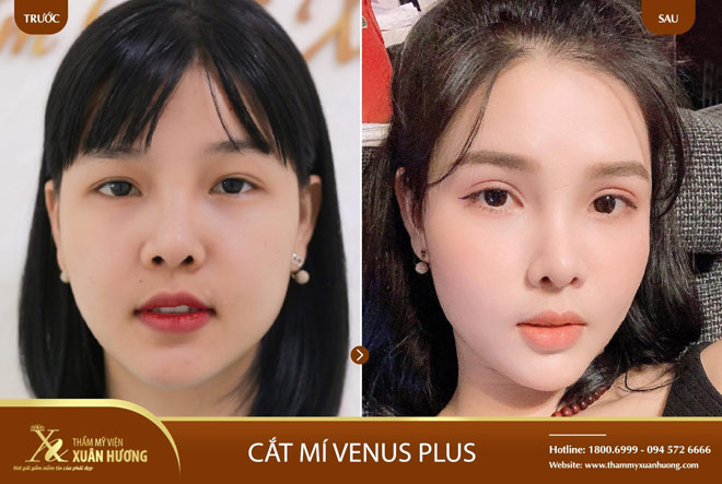 PHƯƠNG PHÁP CẮT MÍ MỞ GÓC MẮT GIÚP ĐÔI MẮT TO TRÒN LONG LANH
