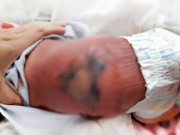 Bà bầu - Mẹ Bình Phước nằm hơ than sau sinh, con 13 ngày tuổi bỏng nặng, hoại tử da