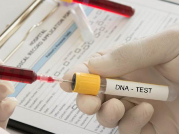 3 tháng sau khi phẫu thuật ghép tủy, người đàn ông sốc nặng khi đi xét nghiệm ADN