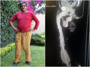 Sức khỏe - Người đàn ông có “cậu nhỏ” dài nhất thế giới: Cái kết đắng khi sở hữu bộ phận kỳ lạ