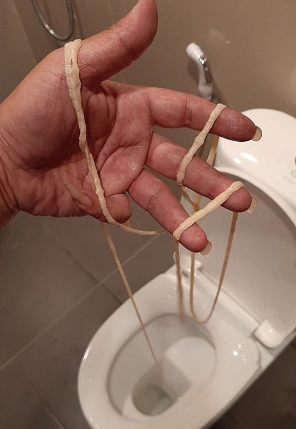Người đàn ông kéo ra sán dây dài 9 mét từ chính cơ thể mình trong lúc đi vệ sinh - 2