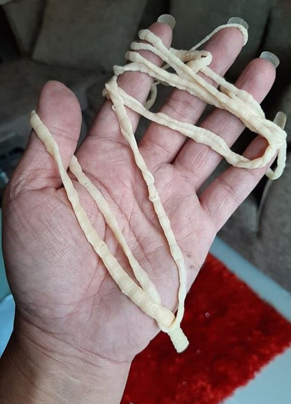 Người đàn ông kéo ra sán dây dài 9 mét từ chính cơ thể mình trong lúc đi vệ sinh - 1