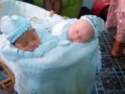 Bà bầu - Bố mẹ đều da đen tóc xoăn, đi đẻ bác sĩ tròn mắt vì lấy ra em bé trắng bóc