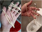 Sức khỏe - Người đàn ông kéo ra sán dây dài 9 mét từ chính cơ thể mình trong lúc đi vệ sinh