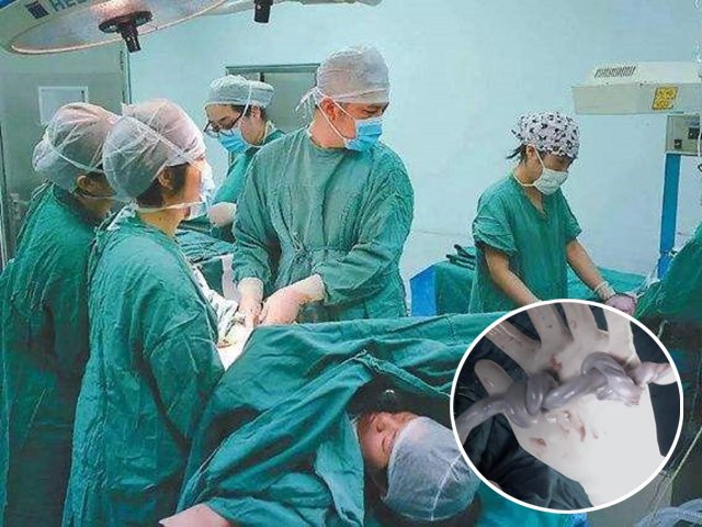 Mổ bắt con cho mẹ Sài Gòn bị suy thai, bác sĩ chứng kiến cảnh hiếm gặp
