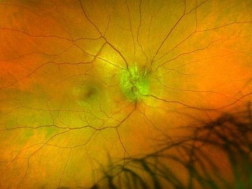 Quan hệ kiểu tai hại này, người đàn ông mắc bệnh giang mai lan tới tận mắt