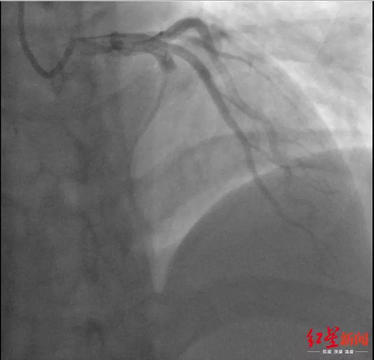 Chàng trai 21 tuổi có 10 cục máu đông trong cơ thể vì thói quen nguy hại nhiều người mắc - 1