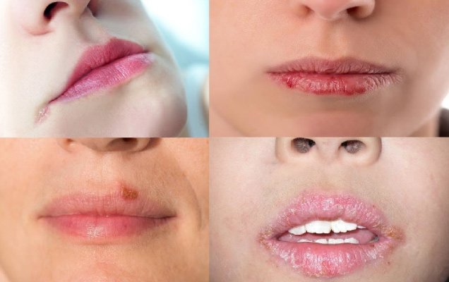 Chốc mép do đâu và cách chữa trị nhanh nhất tại nhà - 1