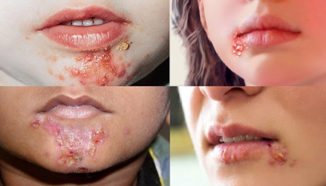 Chốc mép do đâu và cách chữa trị nhanh nhất tại nhà - 2