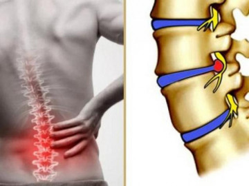 Thoái hóa cột sống, nỗi ám ảnh của người già: Đừng để đau mới lo phòng bệnh