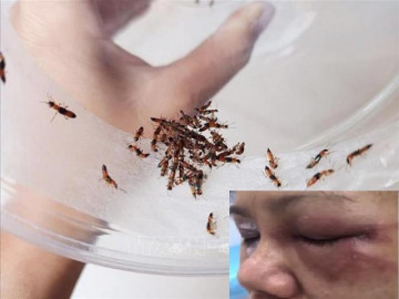 Báo động tình trạng nhập viện do kiến ba khoang: Sai lầm khiến người bệnh tổn thương nặng hơn