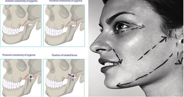 Sự thật về phụ nữ có gò má cao kiếm cả đời không được chồng, lấy được thì sát phu - 3