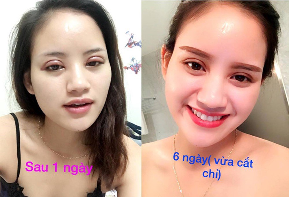 Bỏ tiền đi cắt mí, người phụ nữ nhận cái kết là đôi mắt không thể nhắm - 3