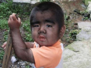 Làm mẹ - Cuộc sống sang chảnh hiện tại của cậu bé lông lá như người vượn nổi tiếng nhiều năm trước