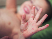 Sức khỏe - Hàng nghìn trẻ mắc tay chân miệng, nhiều ca biến chứng nặng lên não