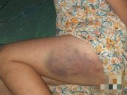 Tin tức - Vụ học sinh lớp 3 bị cô giáo đánh tím đùi: Vì "muốn học sinh tiến bộ"?