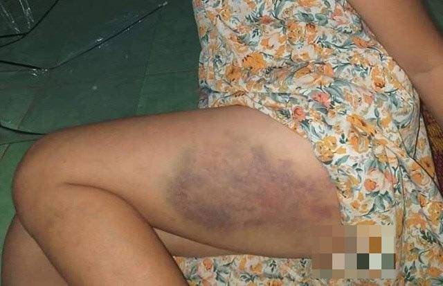 Vụ học sinh lớp 3 bị cô giáo đánh tím đùi: Vì amp;#34;muốn học sinh tiến bộamp;#34;? - 1