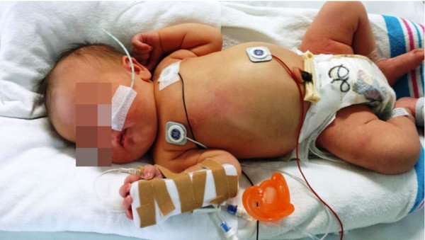 Trẻ 10 ngày tuổi thủng ruột, tử vong vì hành động thiếu sót của cha mẹ khi cho con ăn - 1