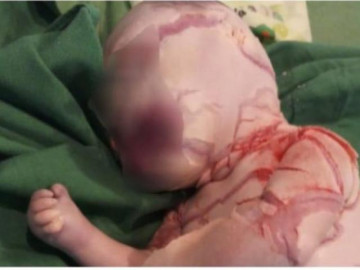 Bé sơ sinh có làn da lạ, 2 bệnh viện hội chẩn tìm phương án điều trị