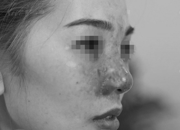 Muốn tiêm filler làm đẹp, nàng nên nắm những lưu ý sau để tránh tiền mất tật mang - 4