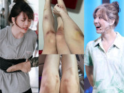 Làm đẹp - Sở hữu đôi chân ngọc ngà, Hari Won và Thiều Bảo Trâm lộ vết thương chi chít ai cũng xót