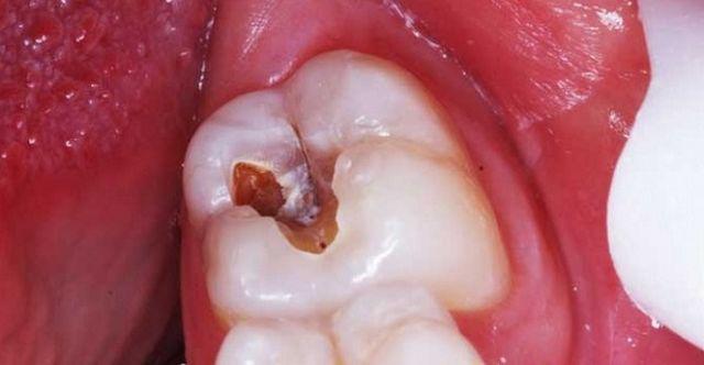 Bé gái 8 tuổi phải phẫu thuật não do sâu răng, cảnh báo không coi thường vệ sinh răng miệng - 4