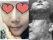 Làm đẹp - Đầu tư tiền làm trẻ hóa căng da, người phụ nữ bị bỏng rộp hết khuôn mặt
