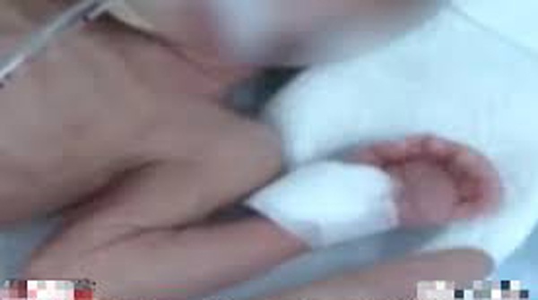 Em bé nửa tháng tuổi bị hoại tử ruột nghi do bố thêm 1 thìa sữa bột khi pha sữa - 1