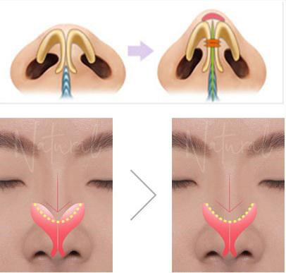 “Khắc tinh” của đầu mũi to! - 3