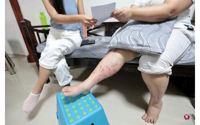 Đi thẩm mỹ viện tẩy lông chân, người phụ nữ tá hỏa khi chân nổi hàng trăm mụn mủ - 1