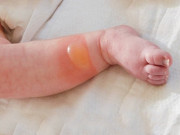 Làm mẹ - Con 4 tuổi bị bỏng mẹ còn đổ thêm một thứ, gia đình phản đối nhưng BS khen hết lời