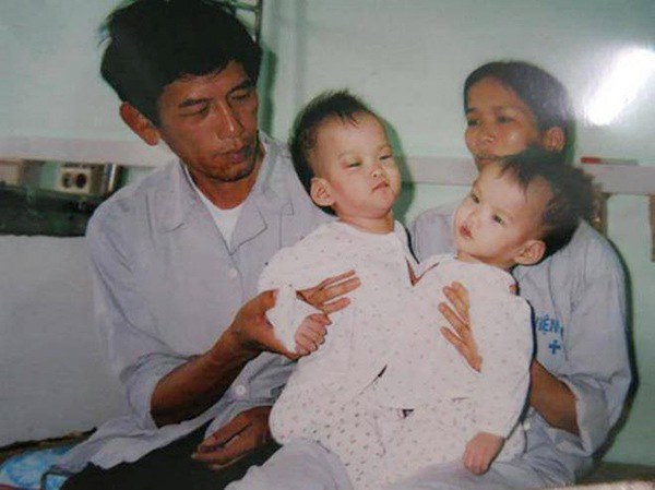 Cặp song sinh dính liền Cúc-An sau 17 năm tách rời: Cả hai vào đại học, tập sống xa nhau - 4