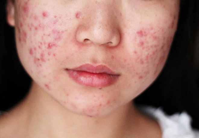 Chuyên gia giải mã lý do vì sao mụn hoài không hết! - 2