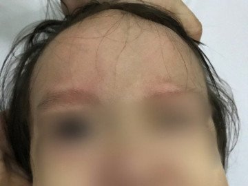 Bé gái 17 tháng tuổi đột ngột liệt mặt sau khi chảy mũi, ngạt mũi