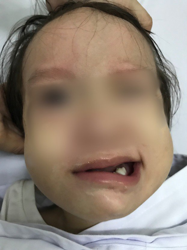 Bé gái 17 tháng tuổi đột ngột liệt mặt sau khi chảy mũi, ngạt mũi - 1