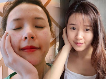 Midu chẳng hề đẹp hoàn hảo: đăng ảnh làn da mụn chi chít, bóc trần thói quen xấu ai cũng mắc