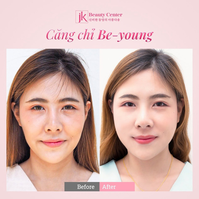 Bật mí về căng chỉ Be-Young – xu hướng trẻ hóa đang được yêu thích - 2