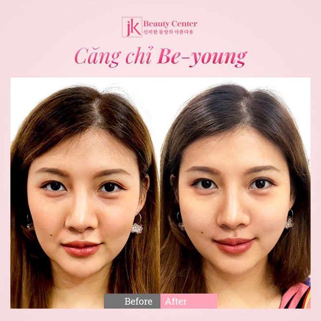 Bật mí về căng chỉ Be-Young – xu hướng trẻ hóa đang được yêu thích - 3