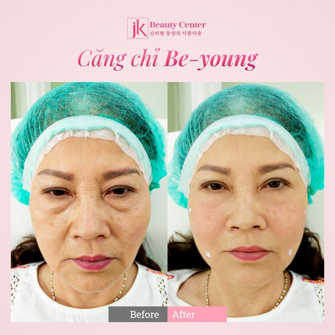 Bật mí về căng chỉ Be-Young – xu hướng trẻ hóa đang được yêu thích - 4