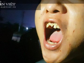 Bắc Ninh: Những cậu bé giúp việc trong quán bánh xèo bị hành hung, tra tấn như thời Trung cổ”!