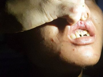 Lời kể của nhân viên quán bánh xèo ở Bắc Ninh: Bị đánh bằng chày, bàn đinh đánh vảy cá