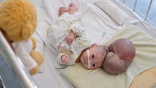 Báo Úc xót xa trẻ em nhiễm chất độc da cam Việt Nam - 2