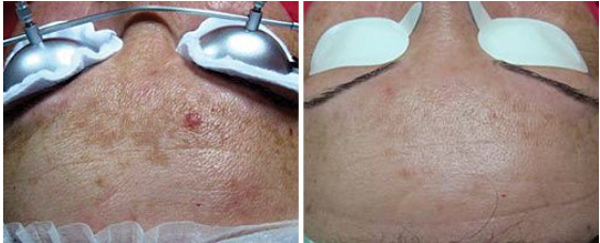 Hệ thống Pensilia Beauty Clinic áp dụng Laser Fotona Starwalker MaQX vào điều trị các bệnh da liễu thẩm mỹ - 3
